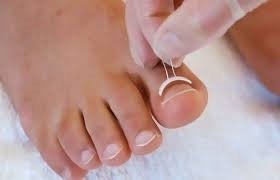 Tırnak Batığı Tedavileri