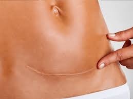 Karın Duvarı Ameliyatı